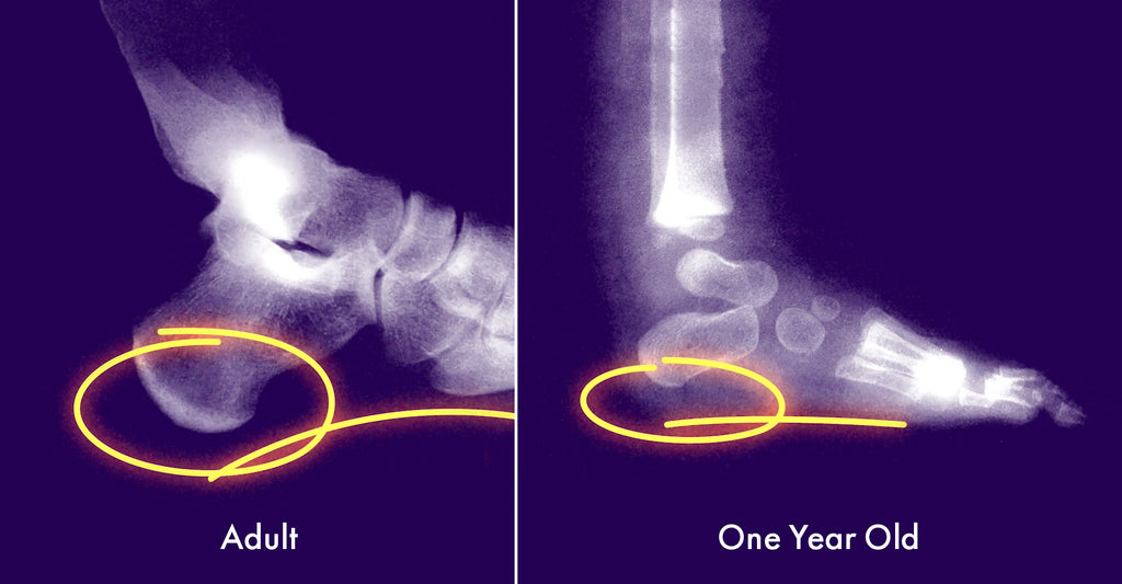 X-ray comparing the differences in the arch of an adult foot vs a one year old foot.